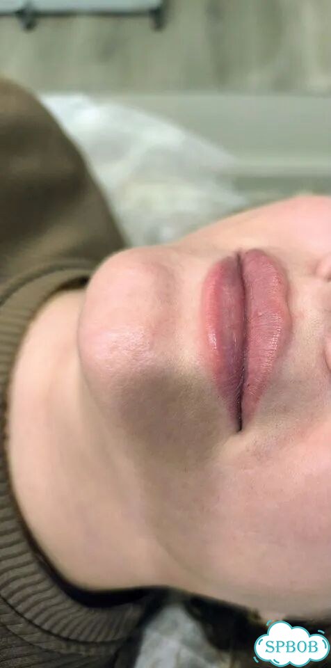 Красивые губы без боли Увеличение и коррекция фото 3