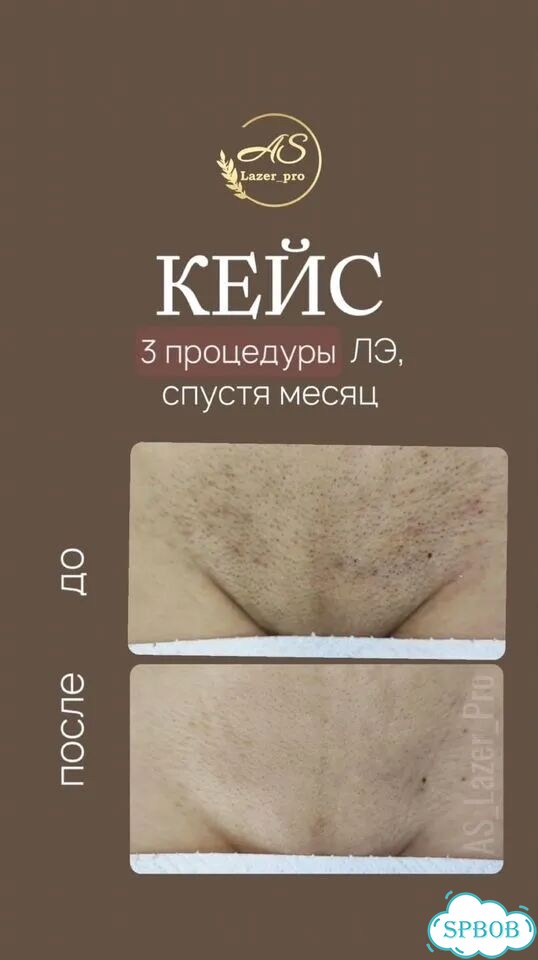 Лазерная эпиляция волос Бикини + Подмышки + Голени фото 3