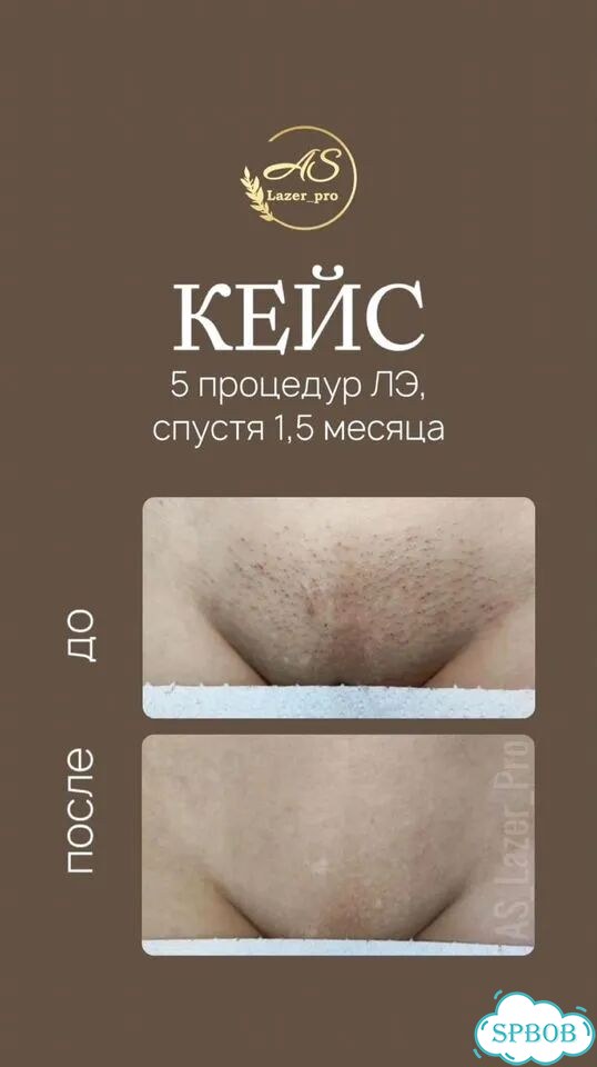 Лазерная эпиляция волос Бикини + Подмышки + Голени фото 4