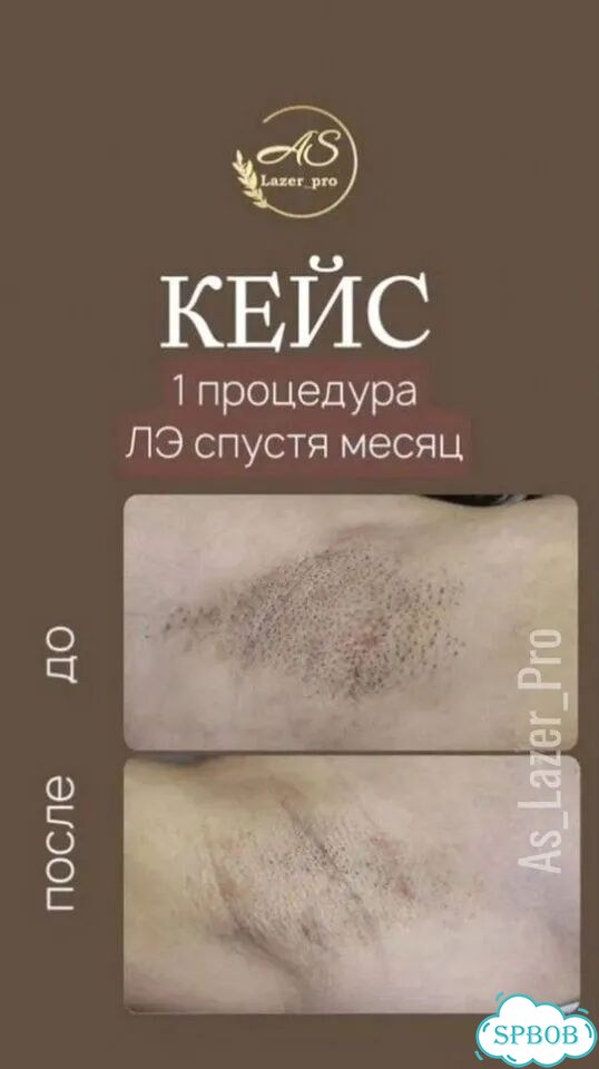 Лазерная эпиляция волос Бикини + Подмышки + Голени фото 5