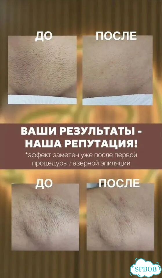 Лазерная эпиляция волос Бикини + Подмышки + Голени фото 6
